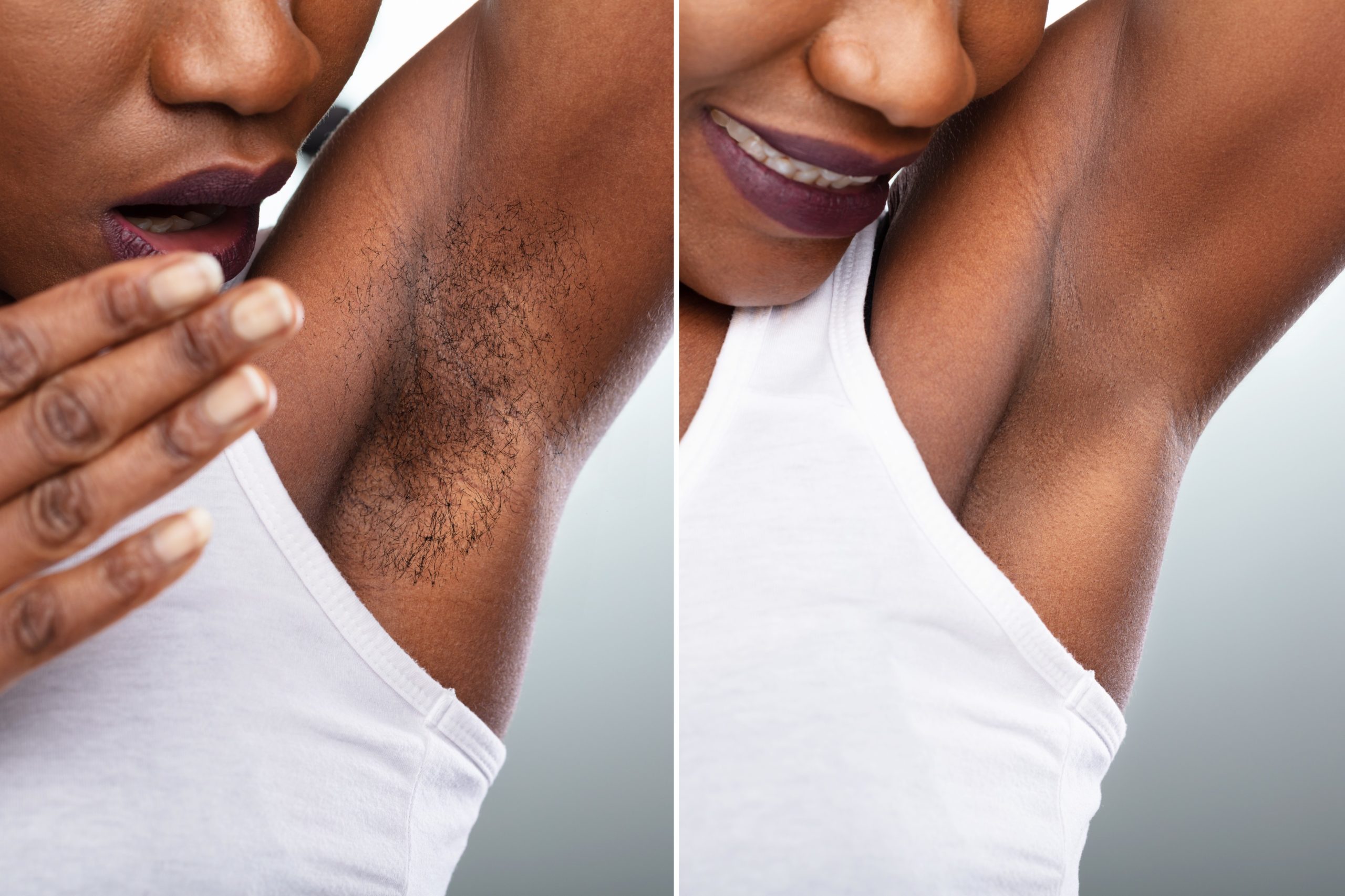 <img src="before.jpg" alt="before and after hair removal"/> 